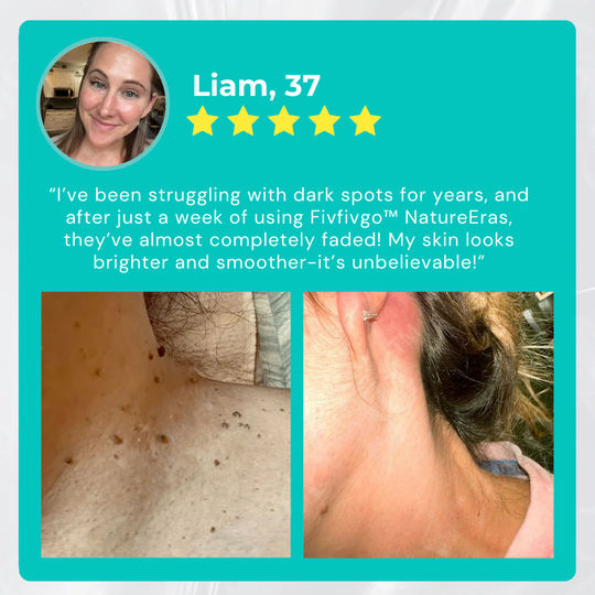 ✅ Boutique officielle : Fivfivgo™ NatureErase Instant Mole & Crème anti-taches