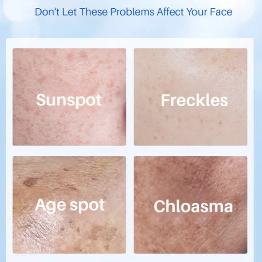 La leche con esencia para manchas de la edad mejora la pigmentación de la piel Crema con esencia Yello para reducir las manchas de la edad