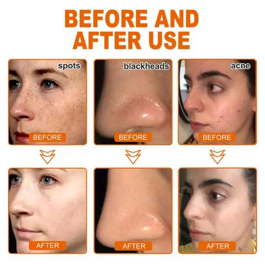 Herbal Spots Peel-Off Facial Mask