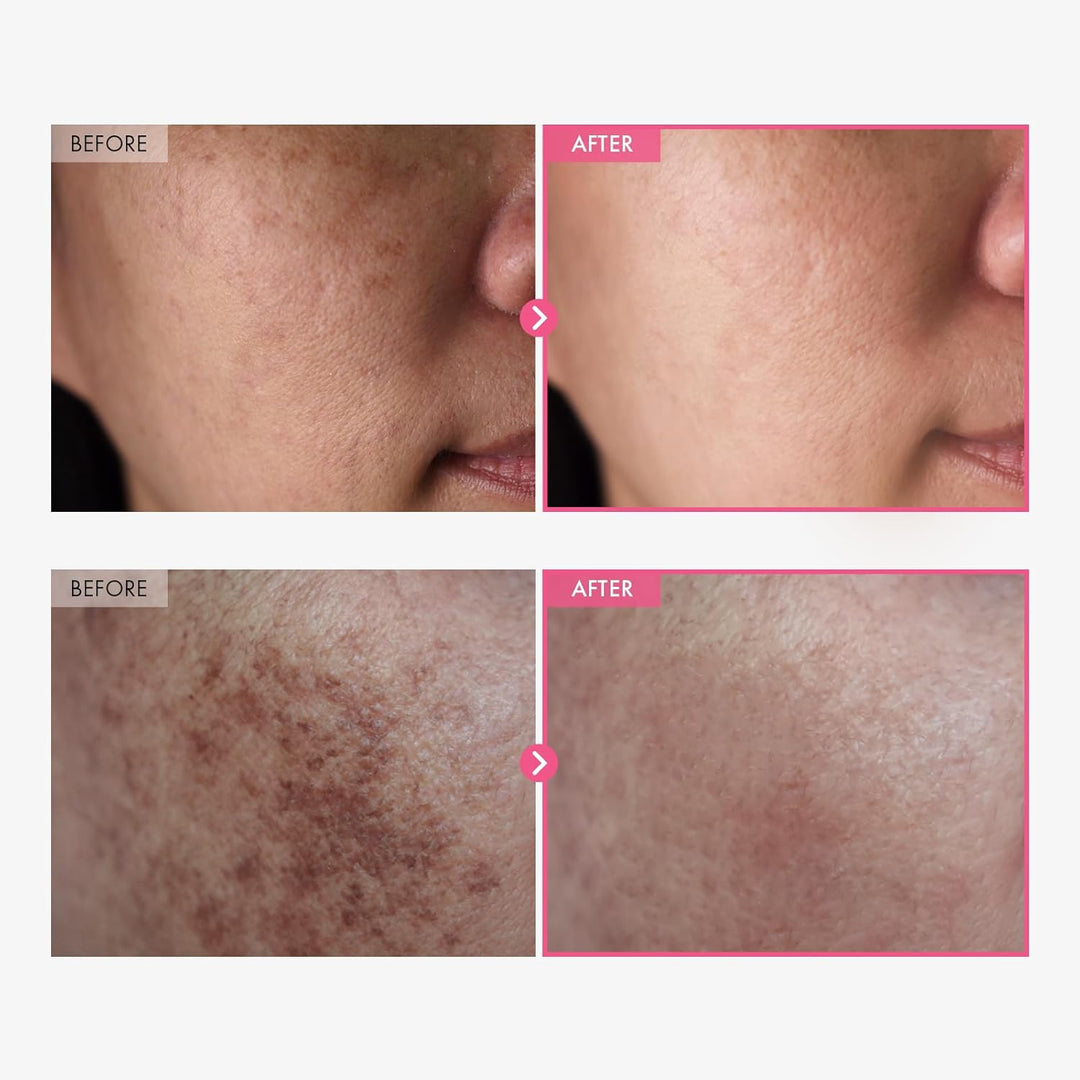 🖤Kara Cuma İndirimi: %40 İNDİRİM🖤Arbutin %7 + Traneksamik Asit %4 Krem