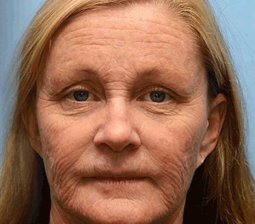 (Made and Shipped from USA) 🧑‍⚕️TLOPA® Botox Bee Venom Wrinkle Removal Cream🔥