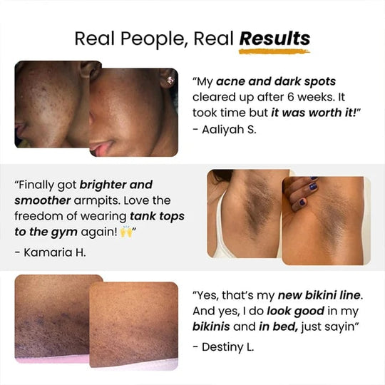 【Înlăturarea petelor magice】Săpun de mână de întunecare cu acid kojic de turmeric