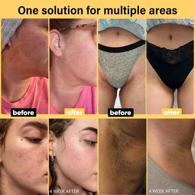 【Înlăturarea petelor magice】Săpun de mână de întunecare cu acid kojic de turmeric