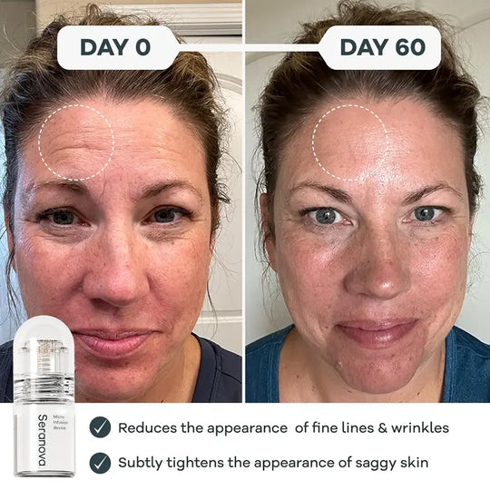 Micro Infusion System for Face & Neck 0.05mm Stamp with Hyaluronic Acid & Collagen Peptide Serum for Firmer Smoother-Looking Skin Easy 5-Minute At-Home Skin Care Application niacinamide - 1 Month Supply