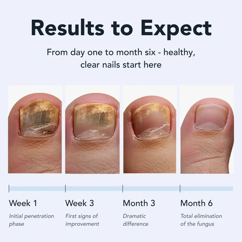 [Lunavia Official]Pen antifungic - ACID UNDECILENIC 25% - Vindecă piciorul majorității atletului, mâncărimea jocului și pecinginele