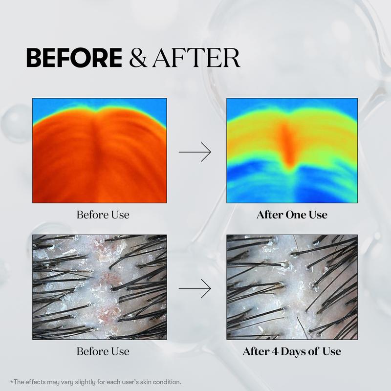 [VT Cosmetics] PDRN Reedle Shot Hair Ampoule 100dl 15ml | Creșterea părului ser fiole pentru tratamentul căderii părului