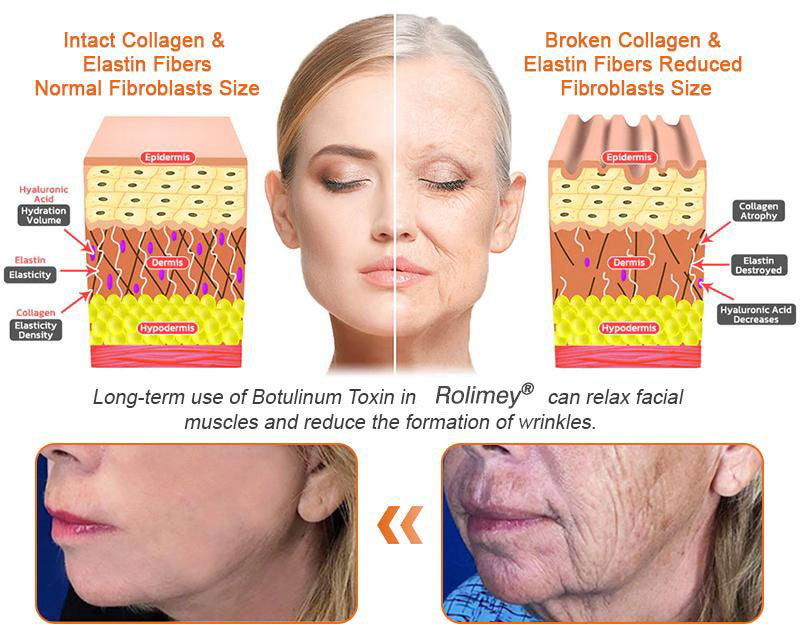 🧑‍⚕️𝑶𝒇𝒇𝒊𝒄𝒊𝒂𝒍 𝑺𝒕𝒐𝒓𝒆 | 𝐑𝐨𝐥𝐢𝐦𝐞𝐲® Botox Bee Venom Firming Serum Stick - Targets Sagging Skin & Wrinkles All Over Body with Advanced Peptide Technology, Visible Results in 3 Days (⏳LAST DAY 40% OFF)