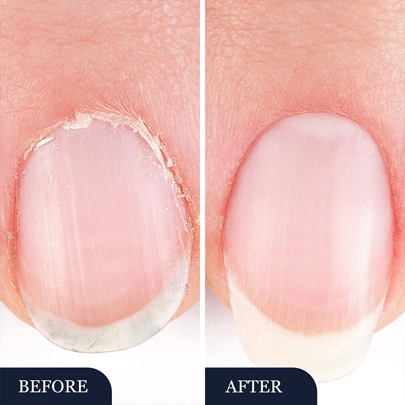 Antifungal Pen - botar de flesta fotsvampar, Jock Itch och ringorm