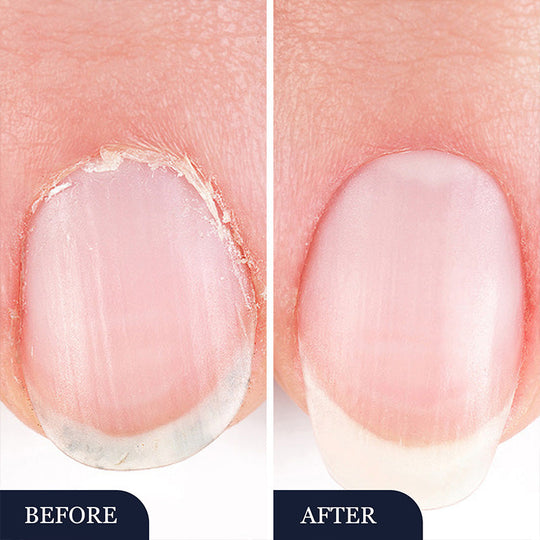 Antifungal Pen - botar de flesta fotsvampar, Jock Itch och ringorm